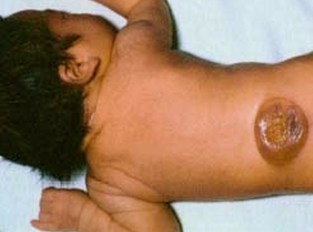 Born Spinal